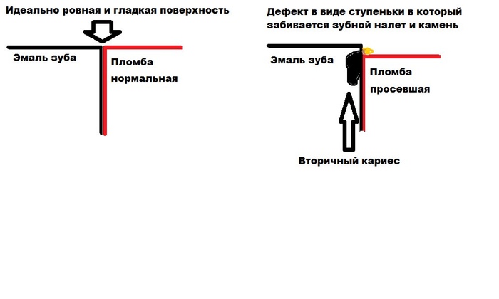 Сага о стоматологии. Глава 11. Зачем менять пломбу? - 28.01.23 14:38